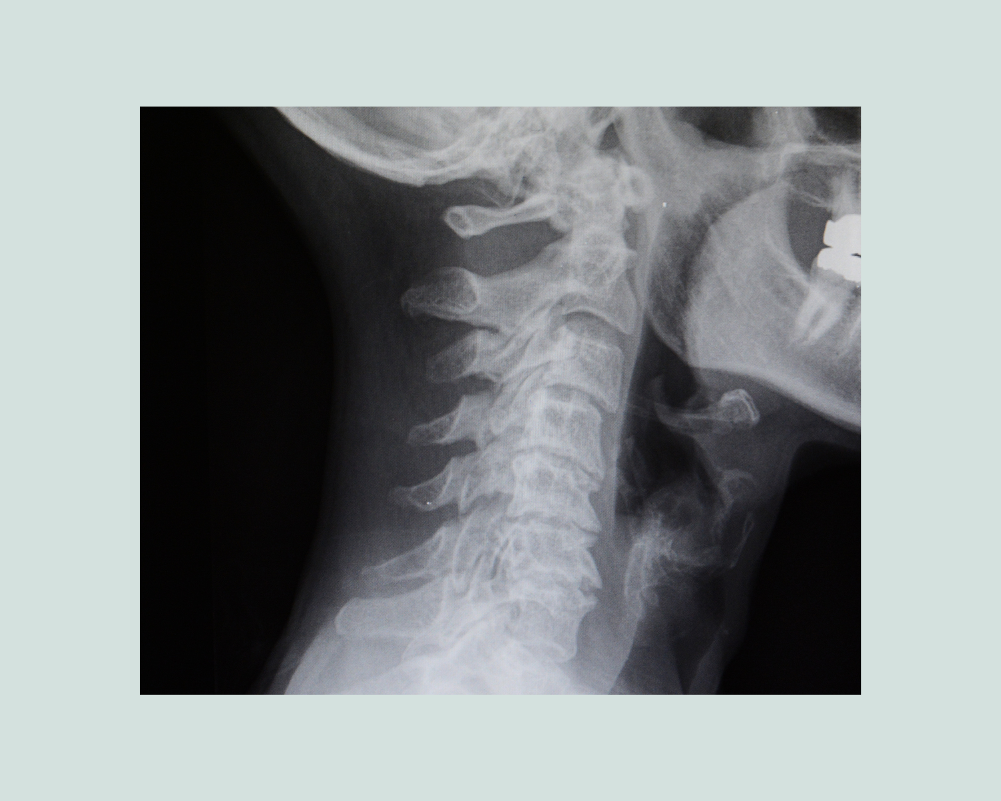 X-ray of a spine